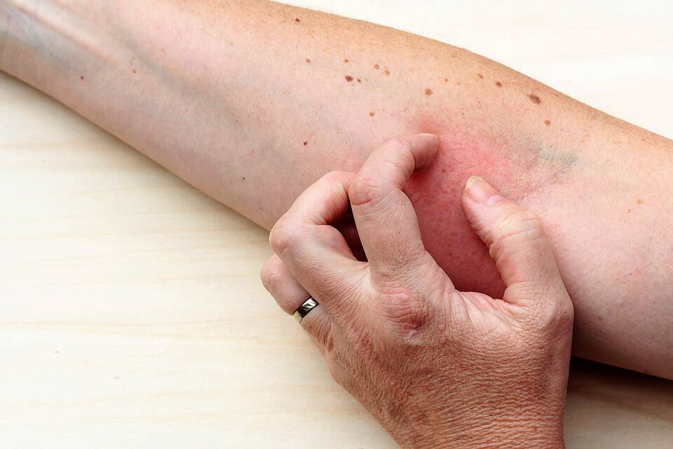 Neurodermitis: Unerträglichen Juckreiz verbunden mit einem immensen Leidensdruck Neurodermitis: Unerträglichen Juckreiz verbunden mit einem immensen Leidensdruck