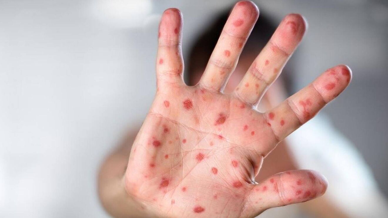 13.000 Mpox-Fälle im Kongo: WHO sieht globales Risiko